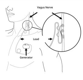 Une électrode stimule le nerf vague gauche au niveau du cou. Cette électrode de stimulation est reliée à un neurostimulateur positionné au niveau pectoral ou au niveau de l'aisselle.